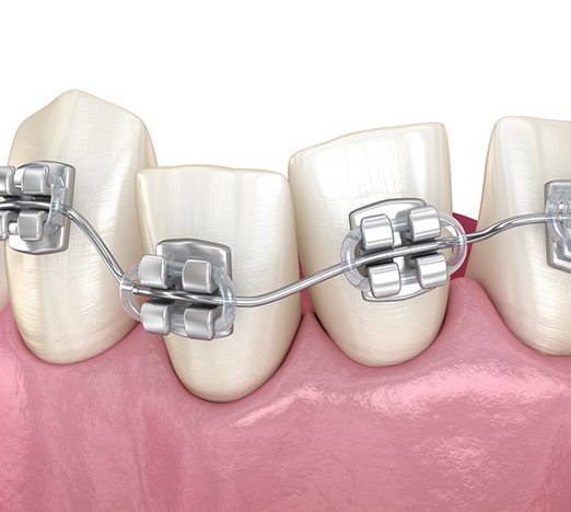 Illustration of braces on crooked teeth