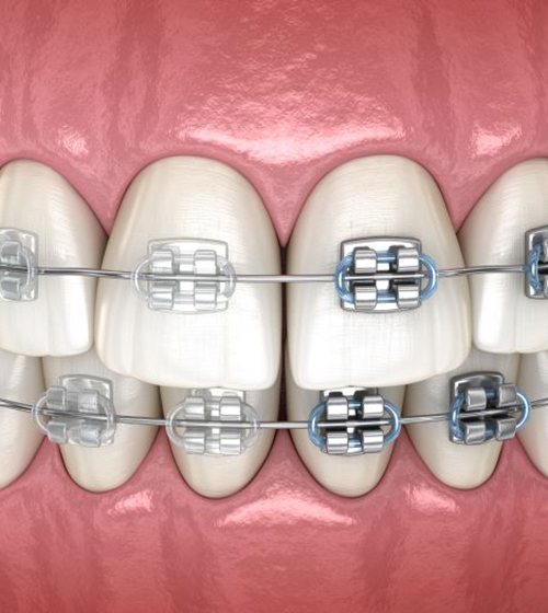 Illustration of teeth with half metal brackets, half clear brackets