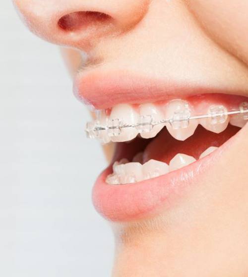 Close-up of person’s smile with clear ceramic braces