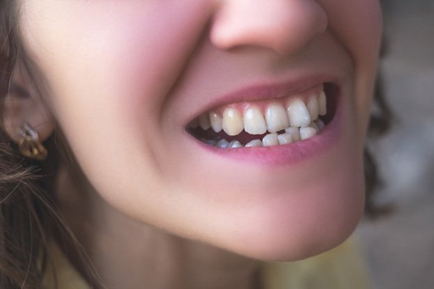 closeup of person smiling with dental crowding 