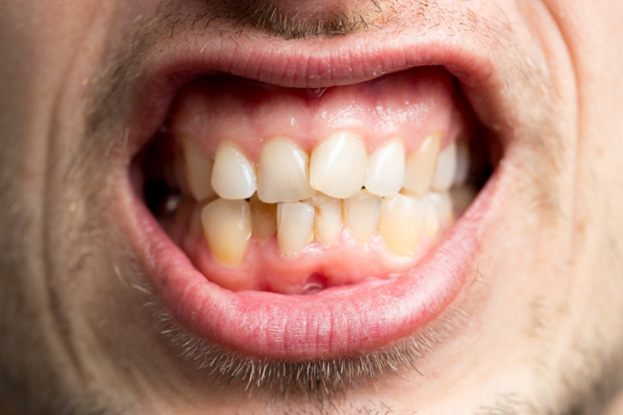 closeup of man with crowded teeth  