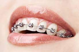 person with braces smiling 